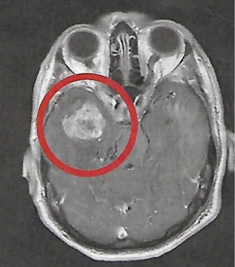 Il glioblastoma di Stefano